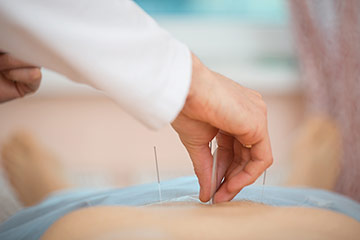 Acupuncture